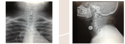<p>A person presents to the ER with difficulty breathing and you suspect a foreign body is lodged in their airway. You get a STN X-ray done and confirm that there is a coin there. In the frontal (AP) view, you see the side of the coin; in the lateral view, you can see the face of the coin. Is this coin stuck in the patient's trachea or esophagus? </p>