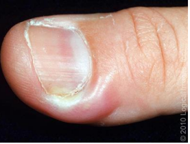 <p>superficial inflammation of the lateral and posterior nail folds surrounding the fingernails or toenails </p><p>-acute is less than 6 weeks, typically bacterial infection (Staph Aureus)</p><p>-chronic is longer than 6 weeks or recurrent episodes (candida) </p><p>-usually involves one finger</p>
