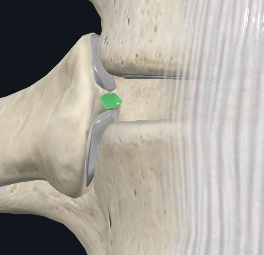 <ul><li><p>The typical rib articulates with —</p><ul><li><p>Bodies of adjacent vertebrae, forming a joint with the head of the rib</p></li><li><p>Transverse process of its related vertebra, forming a costotransverse joint</p></li></ul></li><li><p>Joints with the vertebral bodies are divided into 2 synovial compartments by an intra-articular ligament (image), which attaches to the intervertebral disc</p><ul><li><p>The 2 synovial compartments &amp; the ligament are surrounded by the same joint capsule</p></li></ul></li></ul>