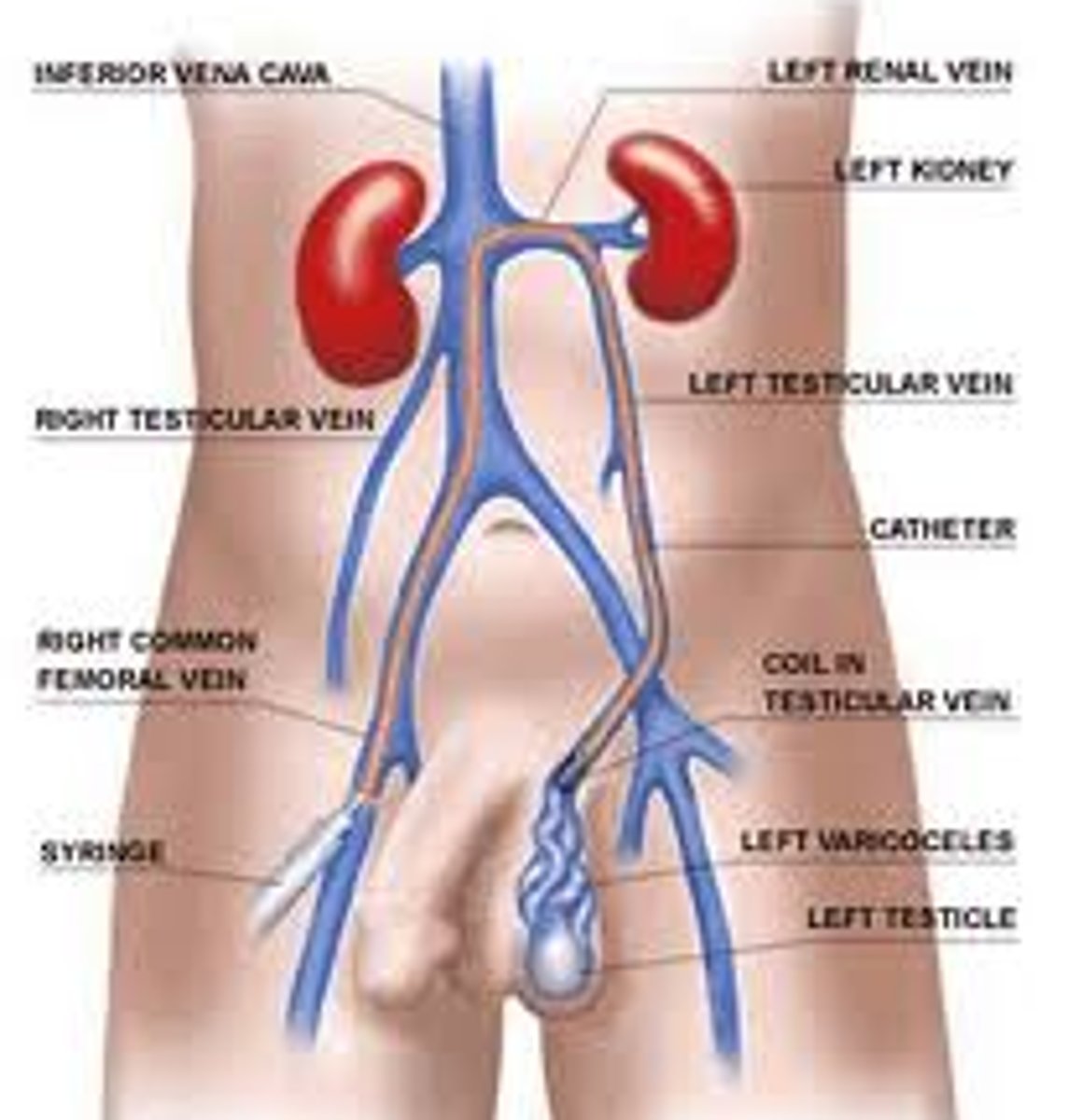 <p>Directly into the inferior vena cava (IVC).</p>