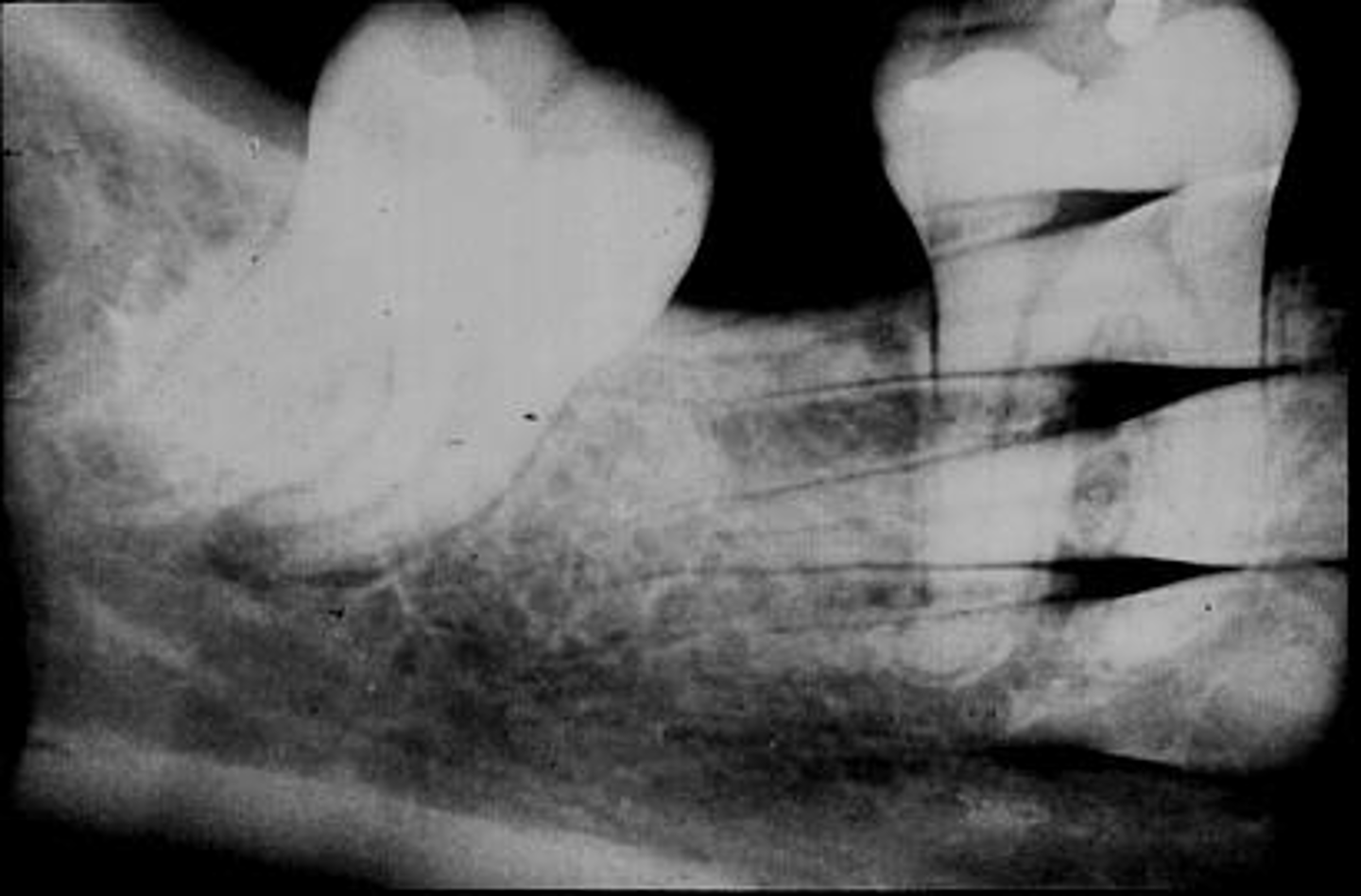 <p>Appearance-A double image appears on the plate</p><p>Cause-The plate was exposed twice in the patient's mouth</p><p>Correction-Always separate exposed and unexposed plates</p>