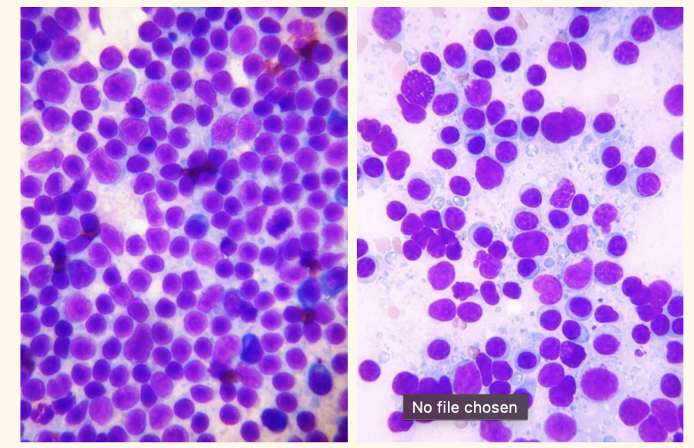 <p>Aspirates from enlarged lymph nodes...</p><ul><li><p>whcih is neoplastic and which is reactive (non neoplastic)</p></li></ul><p></p>