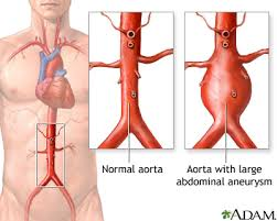 <p><strong>Aortic Aneurysm Clinical Manifestations</strong></p><p>Symptoms</p><p>-Most patients are __________, and their aneurysms are found incidentally </p><p>-Some patients may report abdominal, _____, or back pain</p><p></p><p>Physical Exam</p><p>-Abdominal _____</p><p>-Pulsatile mass</p>