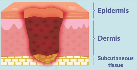 <p><strong>3 layers</strong> of skin damage (epidermis, dermis &amp; subcutaneous) </p><p>full thickness skin loss into the <strong>subcutaneous fat</strong>; wound may tunnel under the edges of the wound bed</p>