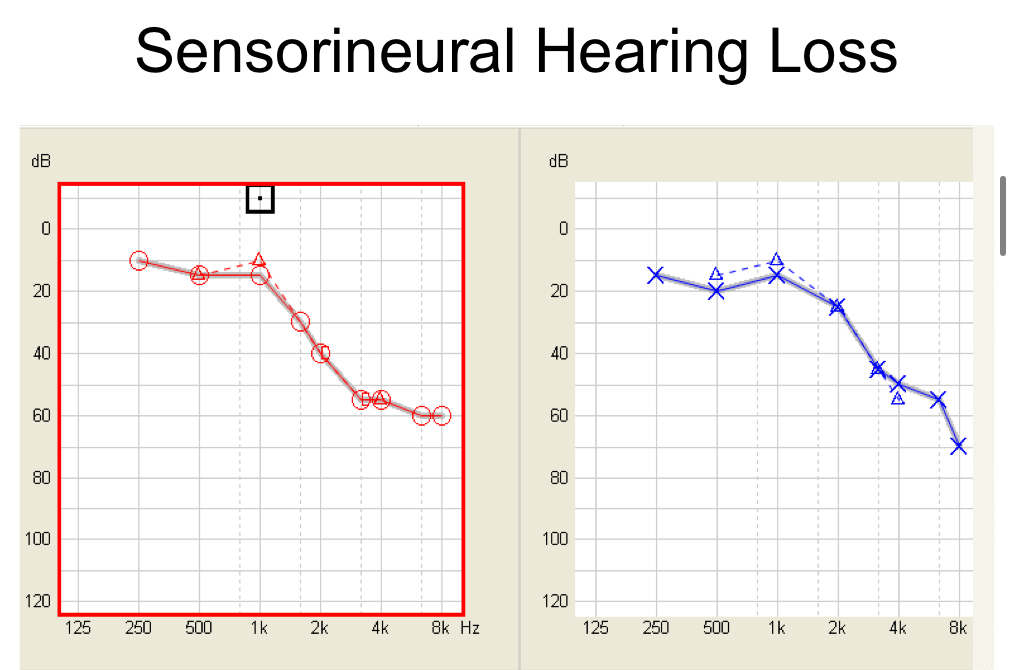 Sensory-neural hearing loss