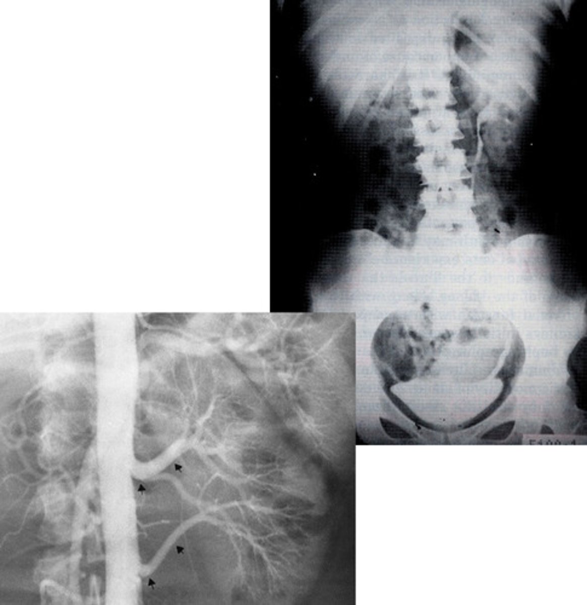 <p>- What congenital anomaly is the absence of one kidney and ureter?</p><p>- How does the kidney that is present appear to compensate for the other not being there?</p><p>- How many renal arteries are present in the bottom radiograph?</p>