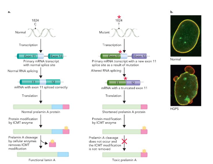 <ul><li><p>fatal disorder that causes accelerated aging in children</p></li><li><p>commonly caused by a mutation in humans </p></li><li><p>changes the nucleotide at position 1824 in the coding sequence of exon 11 from C to T in the lamin A gene, which leads to a different splicing of exon 11 to exon 12</p></li><li><p>splicing leaves about 150 nucleotides missing and results in a shortened prelamin A precursor protein</p></li><li><p>precursor protein gets modified by the enzyme ICMT, which normally gets removed to create a functional lamin A protein, but in the mutant form the modification is retained and leads to the accumulation of the mutant protein in the nuclear membrane</p></li><li><p>the buildup of the altered protein damages the structure and function of nuclei, which leads to premature cell death </p></li><li><p>bioinformatics made it possible to diagnose the disease earlier and develop new potential treatments</p></li></ul><p></p>