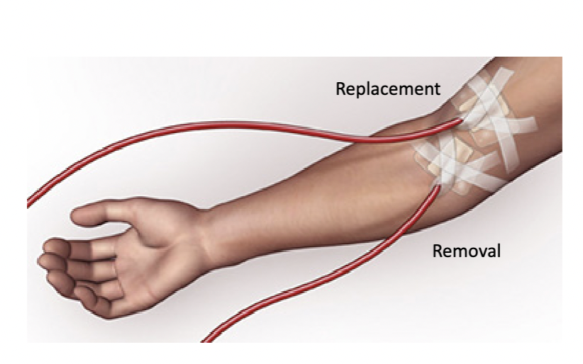 <p>How is dialysis performed using a fistula or graft?</p>