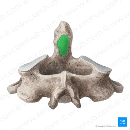 <p>Vertebrae with small body with dens Dens articulates with C1 (atlantoaxial joint); Primary movement = lateral rotation</p>