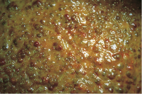 A 57-year-old woman has had increasing abdominal enlargement for six months. During the past two days, she developed a high fever. On physical examination, her temperature is 38.5° C. The abdomen is enlarged and diffusely tender and there is a fluid wave. Paracentesis yields 500 mL of cloudy yellowish fluid. The cell count is 532/μL with 98% neutrophils and 2% mononuclear cells. A blood culture is positive for Escherichia coli. The representative gross appearance of her liver is shown in the figure. Which of the following underlying diseases most commonly accounts for these findings?