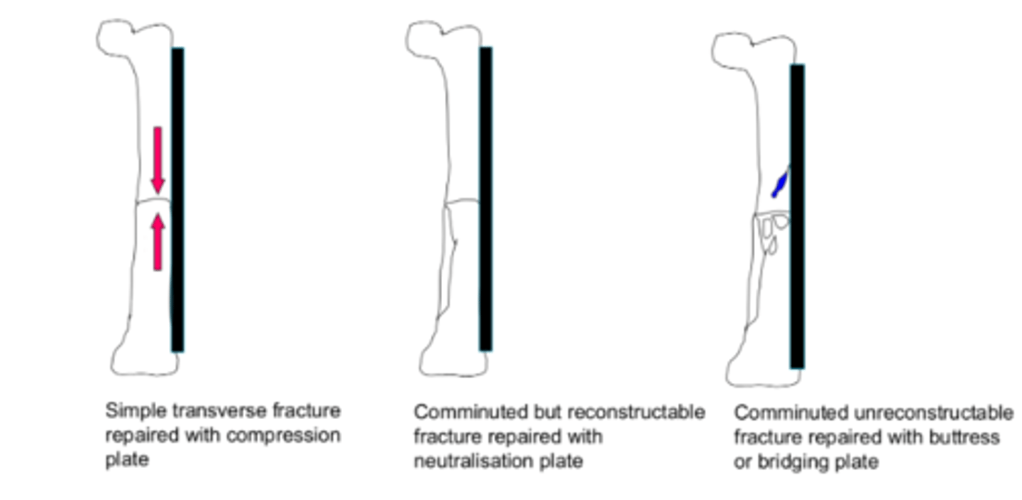 <p>-strong central section that bridges comminuted section of fracture</p><p>-plate takes all of load</p>
