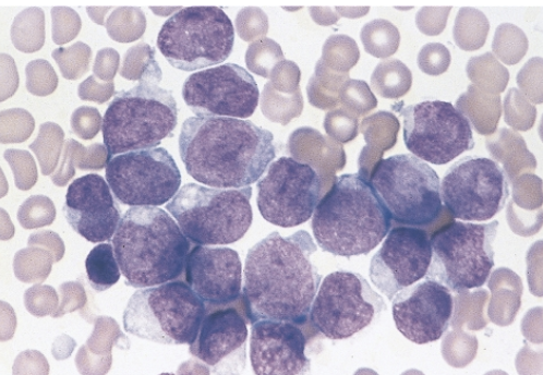 <p>which AML translocation is associated with the following information:</p><ul><li><p>6% of AML cases</p></li><li><p>increase in monoblasts and immature monocytes&nbsp;</p></li><li><p>blasts are large with abundant cytoplasm and fine nuclear chromatin&nbsp;</p></li><li><p>blasts may have pseudopodia, granules and vacuoles</p></li><li><p>typically in children</p></li><li><p>skin and gum involvement may occur</p></li></ul><p></p>