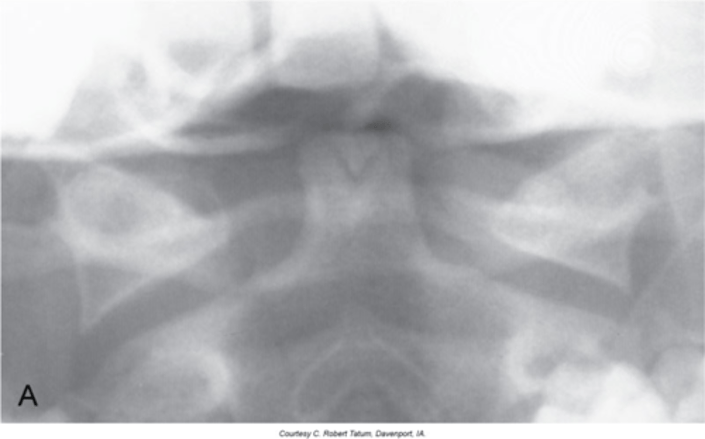 <p>"V" shaped lucent area at the very tip of the dens with a small rounded ossicle within the radiolucent area</p>