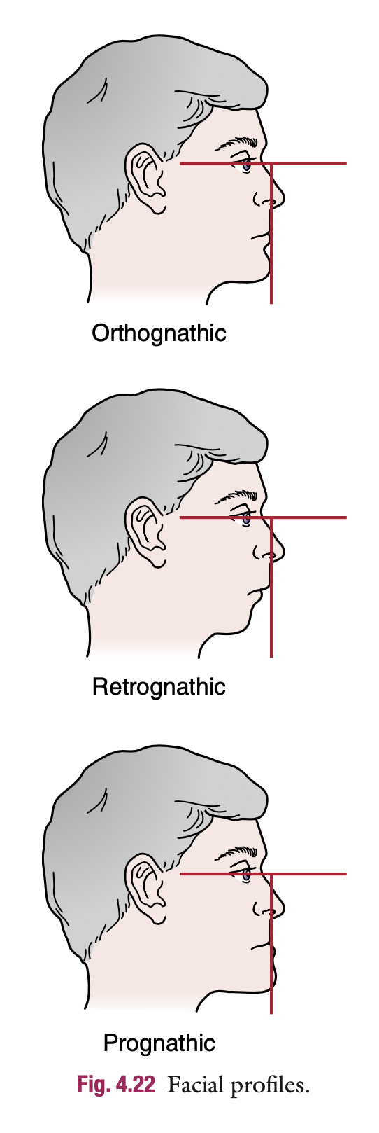 <p>Facial Profile:</p><p>Normal Orthoganthic profile is </p>