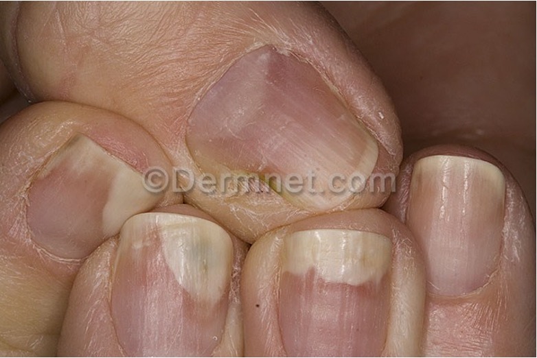 <p>separation of nail plate from bed; starts distally</p><p>ex: trauma, excess manicuring, psoriasis, diabetes, drug reaction</p>