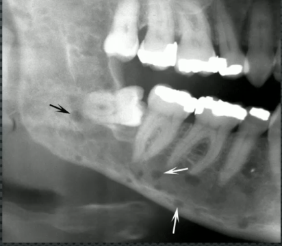 <p>punch out lesion with sharp boundary but NON-CORTICATED</p>