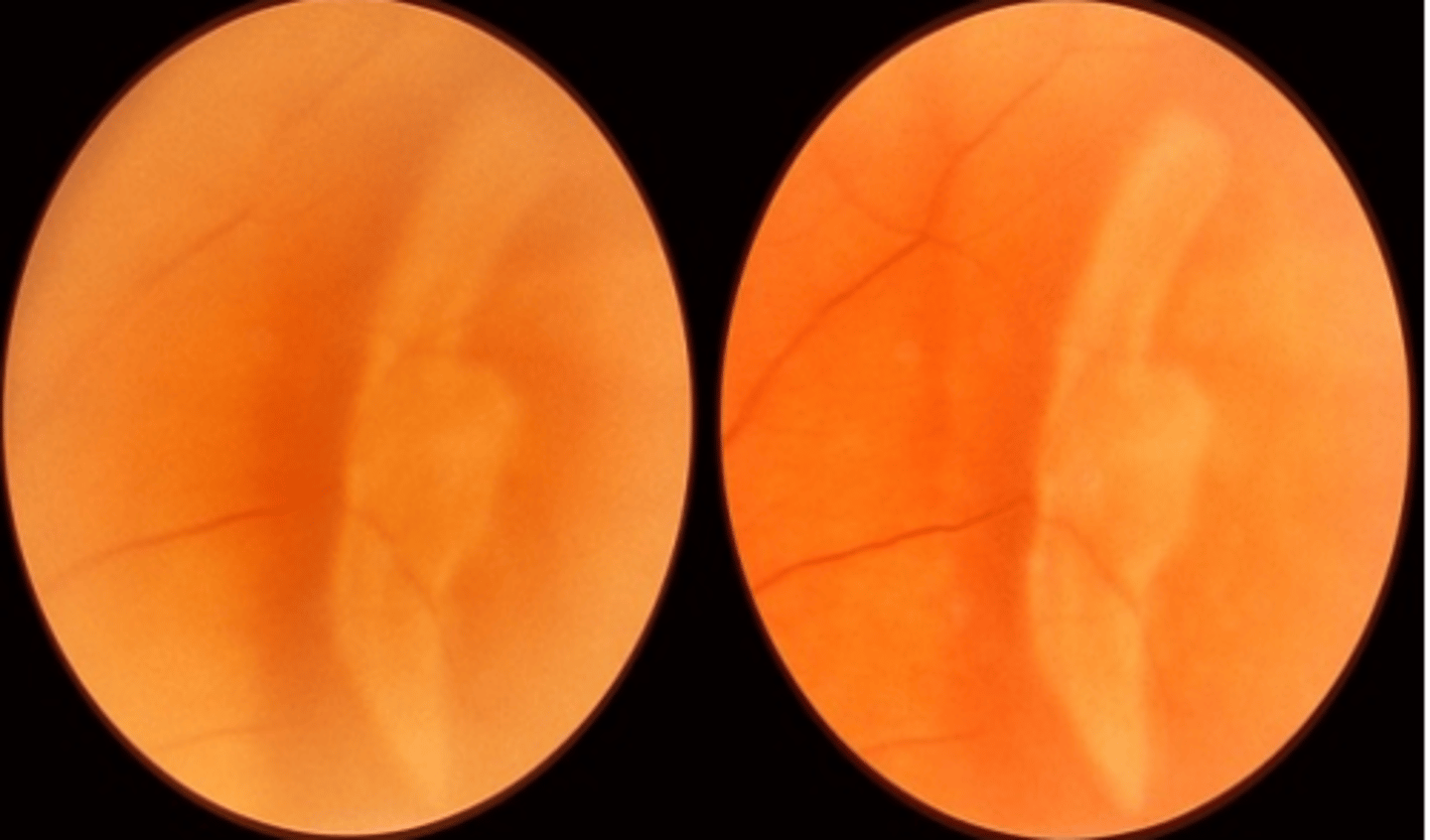 <p>white appearance of the peripheral retinal observed in 32% of patients upon scleral depression. Does not indicate the presence of retinal disease.</p>