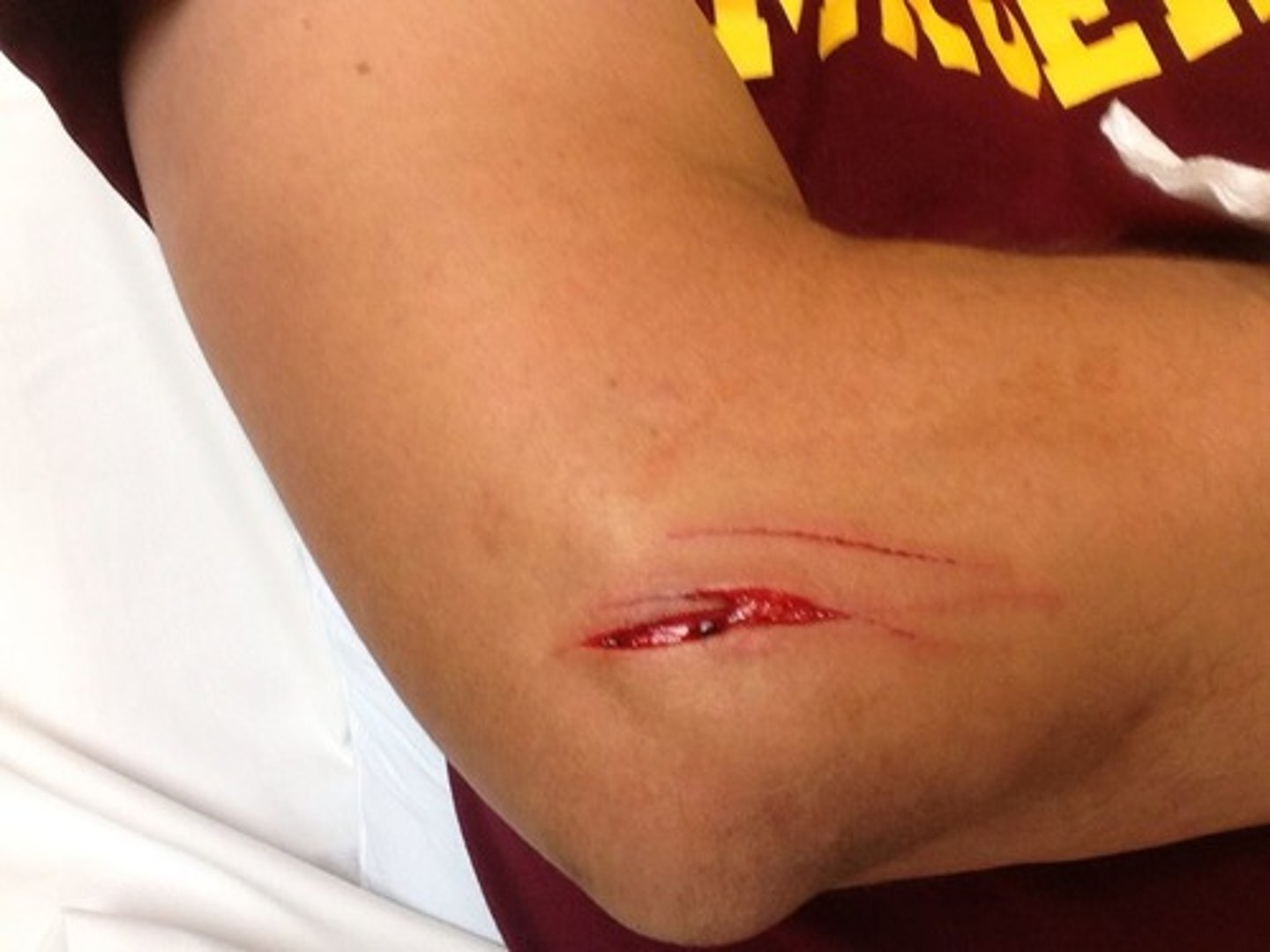<p>Laceration</p>