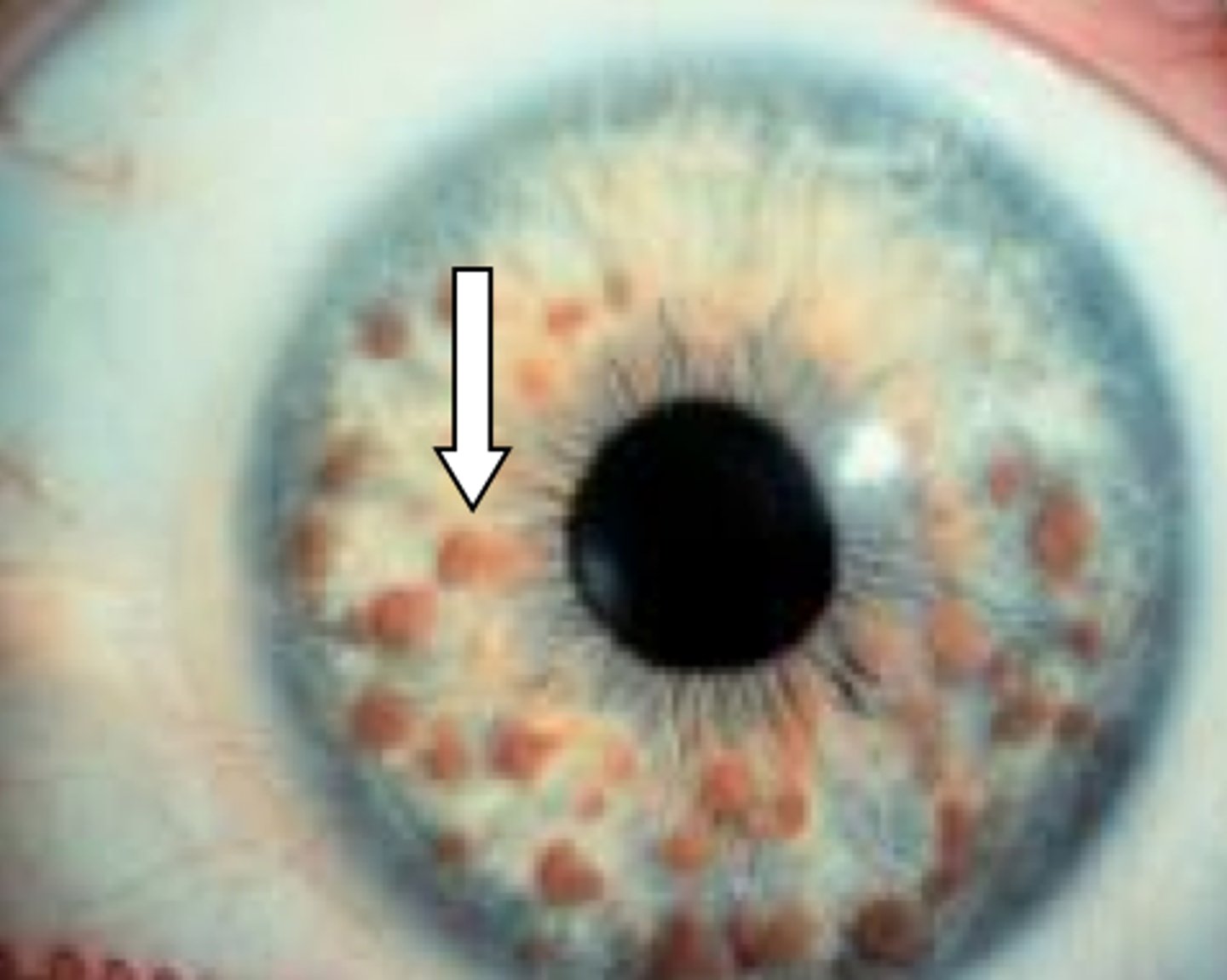 <p>lisch nodules</p>