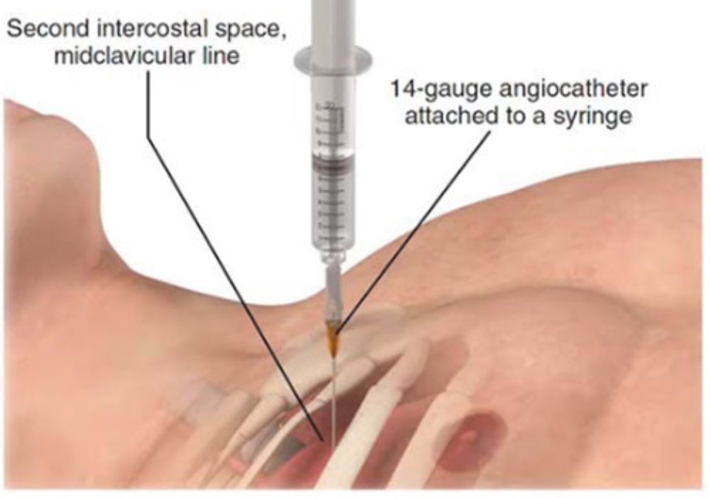 <p>- O2</p><p>- one-way valve seal</p><p>- chest tube = large needle into 2nd ICS to decompress air &amp; allow for reinflation</p>
