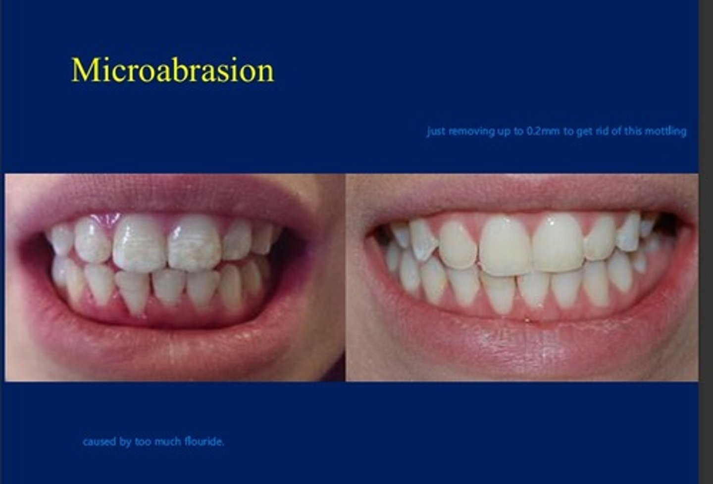 <p>chemically and mechanically removing up to 0.2 mm to get rid of slight staining. Staining that would indicate this treatment is usually caused by too much flouride in the diet.</p>