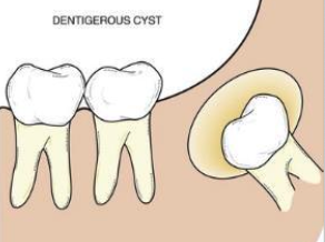 <p>What is a dentigerous cyst?</p>