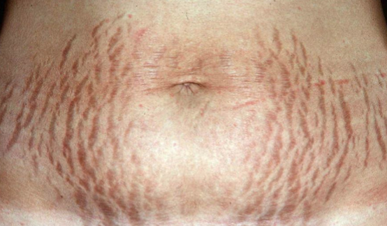 <p>Common Skin Variation</p><ul><li><p>“Stretch marks”</p></li><li><p>Usually permanent unless given professional treatment</p></li></ul><p></p>