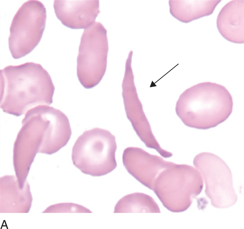 <p>what is a drepanocyte (sickle cell)?</p>