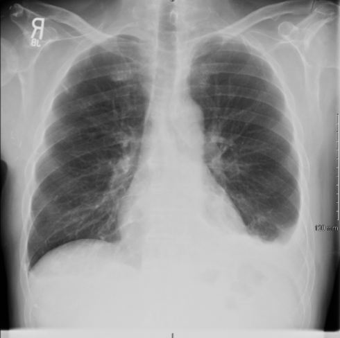 <p>Pleural Effusion: CXR</p>