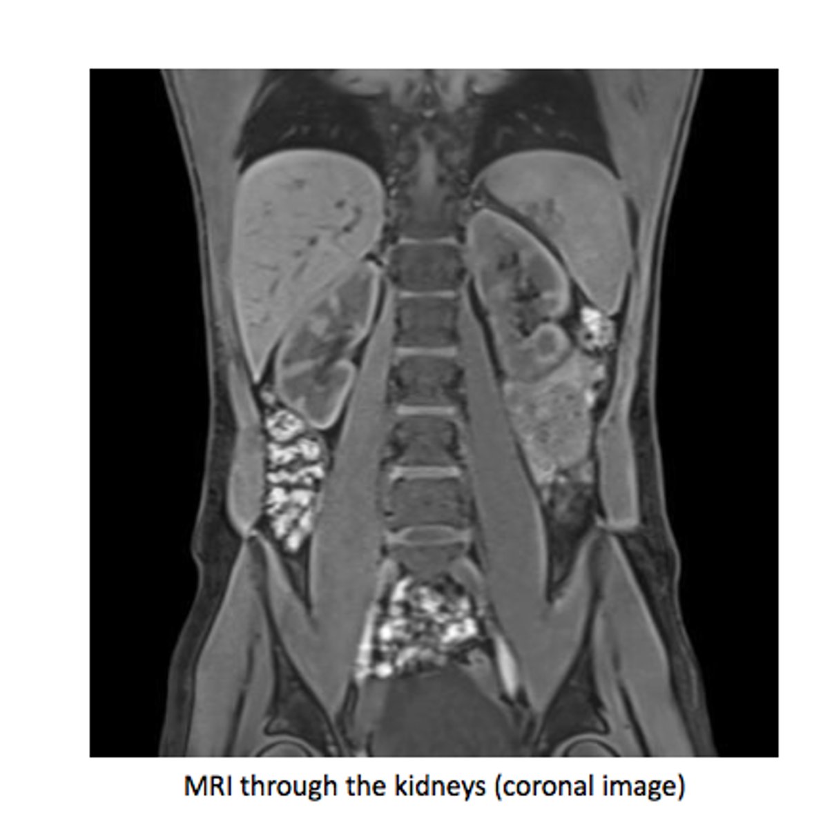 <p>Kidneys decrease in size.</p><p>Reduced renal blood flow.</p><p>Decreased filtration rate.</p><p>Bladder capacity decreases.</p><p>More frequent urination.</p>