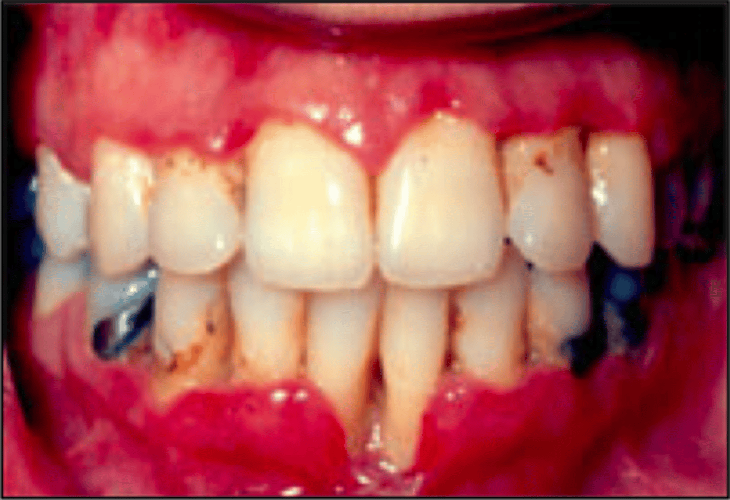 <p>Pathogen: 2 or more species of anaerobic bacteria</p><p>S+S: Painful bleeding of the gingivae, fever, swollen cervical lymph nodes, extreme halitosis</p><p>Prevention: Maintain good oral hygiene (not contagious)</p>