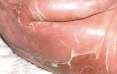 <p>• Staphylococcus aureus toxin breaks apart desmosomes</p><p>• Life-threatening, admit</p><p>Penicillinase-resistant, anti-staphylococcal –nafcillin, oxacillin etc; Vanc for MRSA</p>