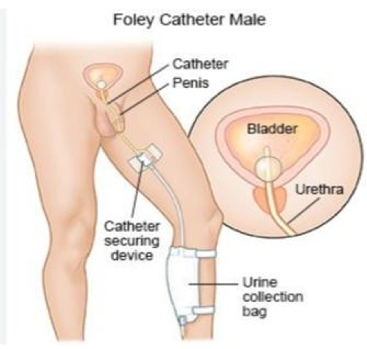 <p>Indwelling urinary catheter.</p>