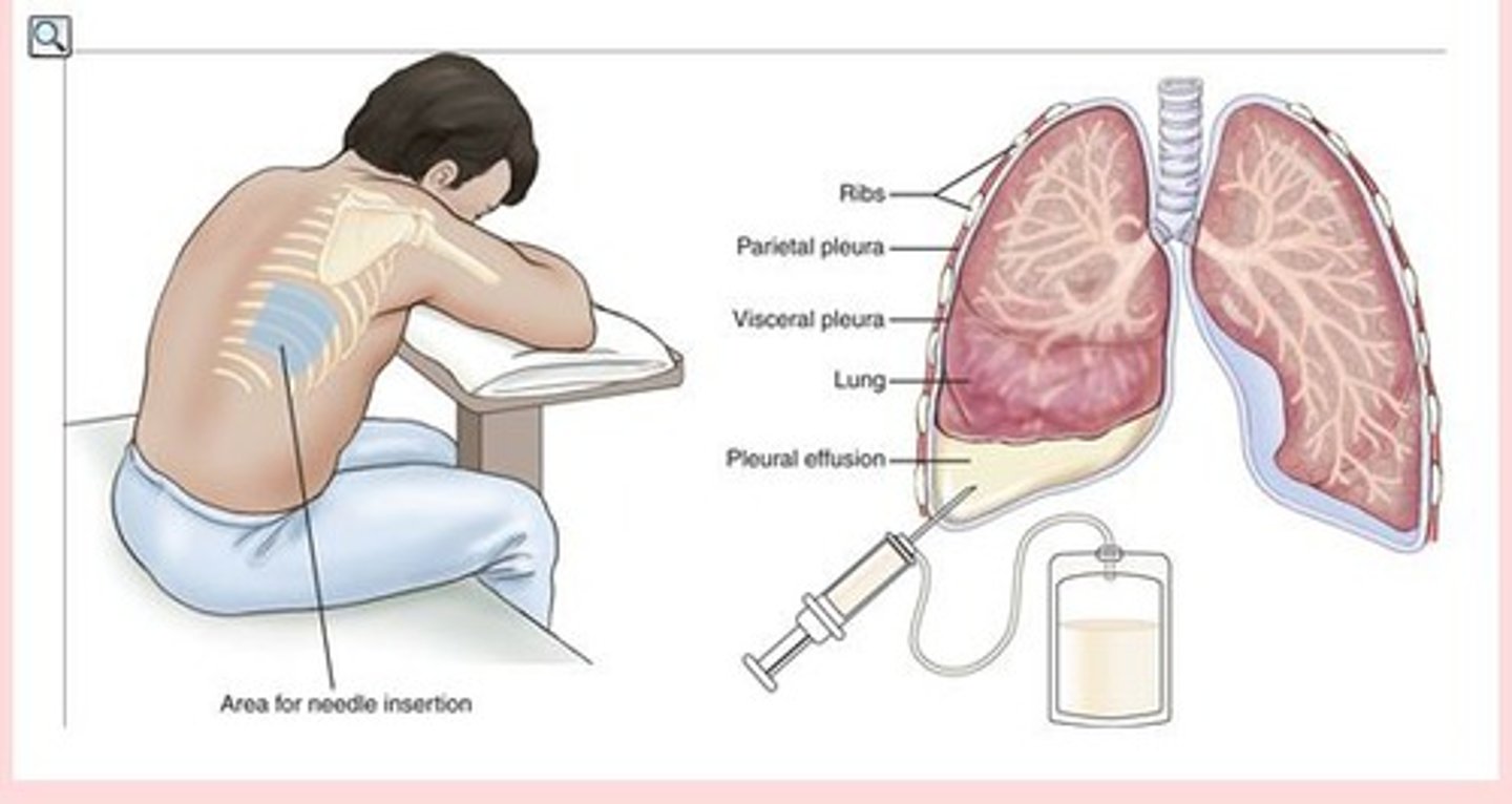 <p>surgical puncture to aspirate fluid from the chest cavity (also called thoracentesis) (Exercise Figure F)</p>