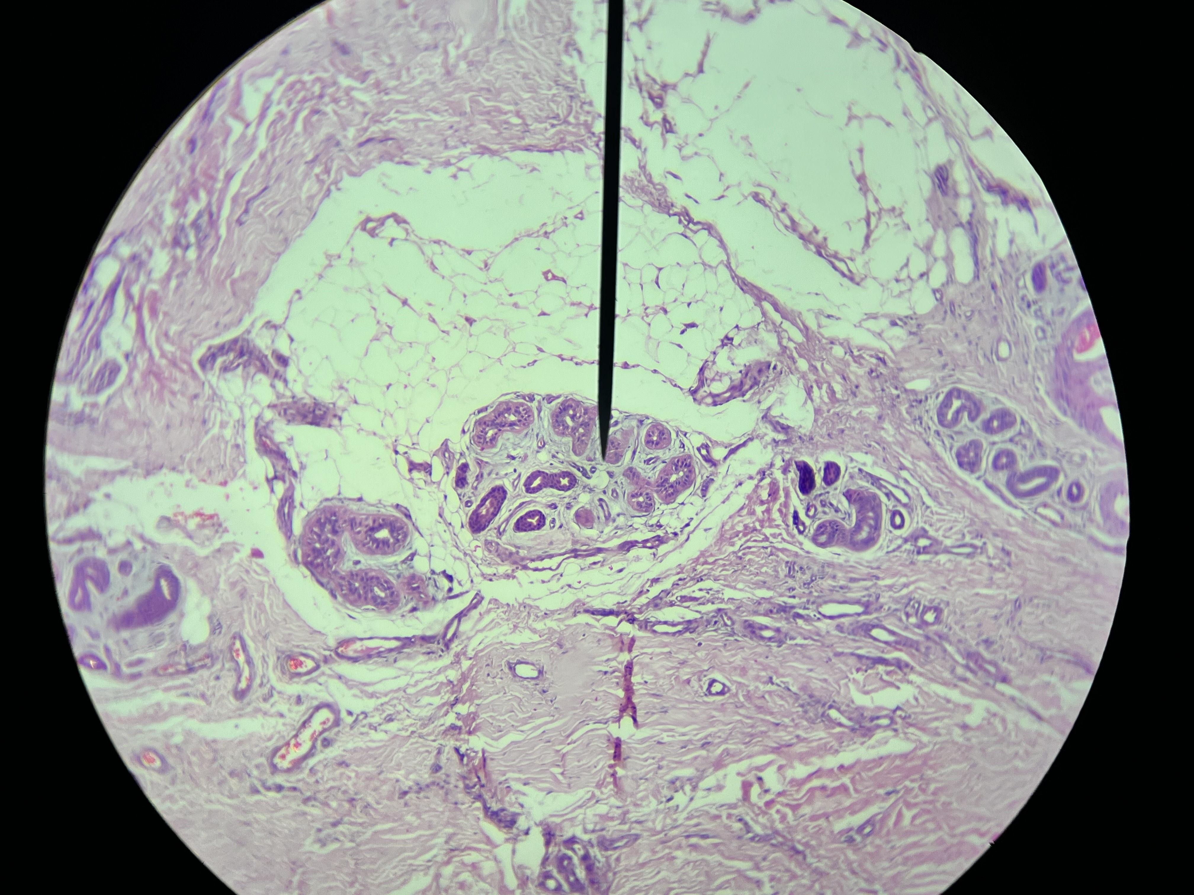 <p><span>presence of molluscum bodies within the epidermis, characterized by large eosinophilic cytoplasmic inclusions in the keratinocytes.</span></p>