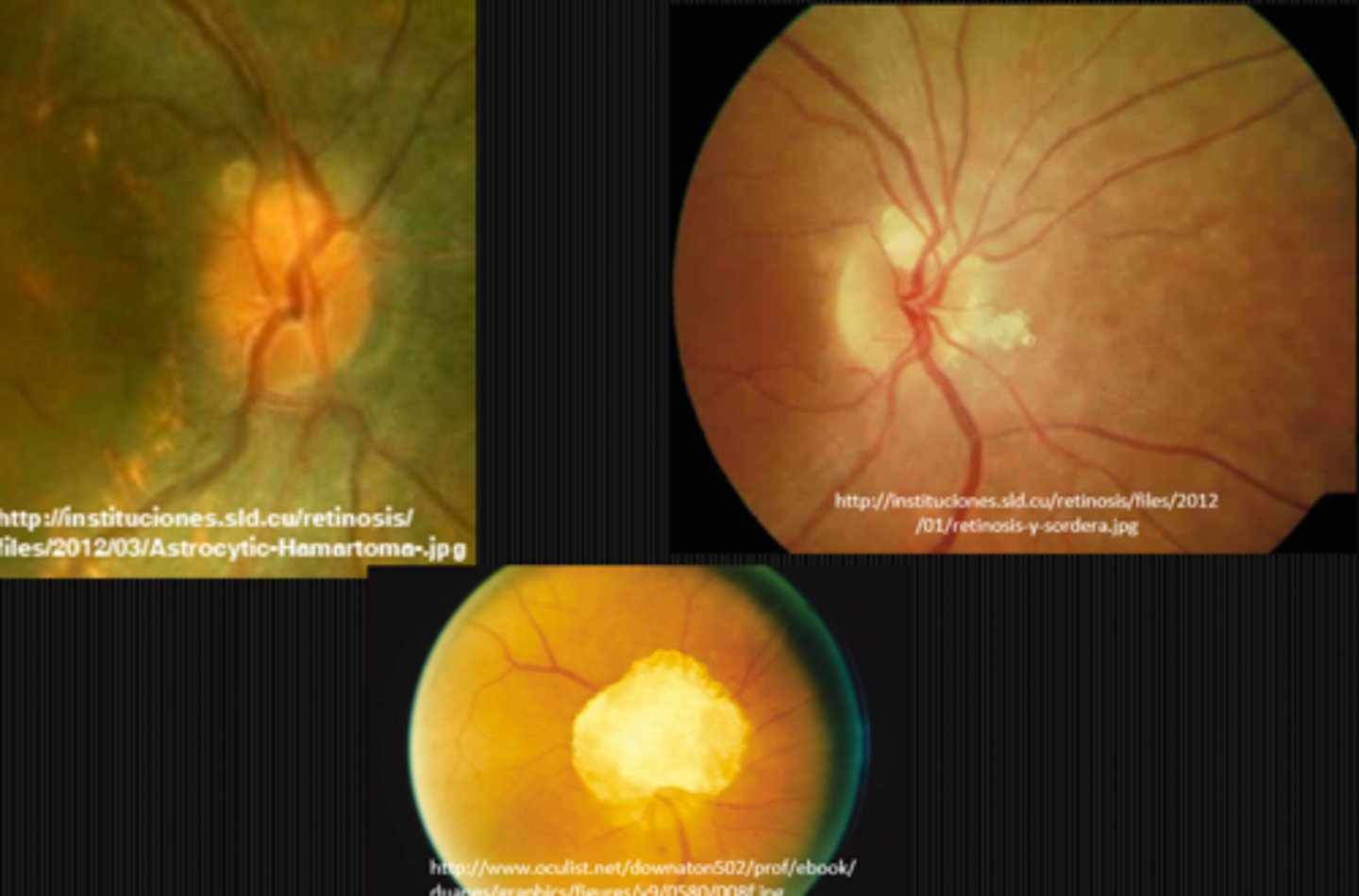 <p>giant hamartoma of the ONH</p>