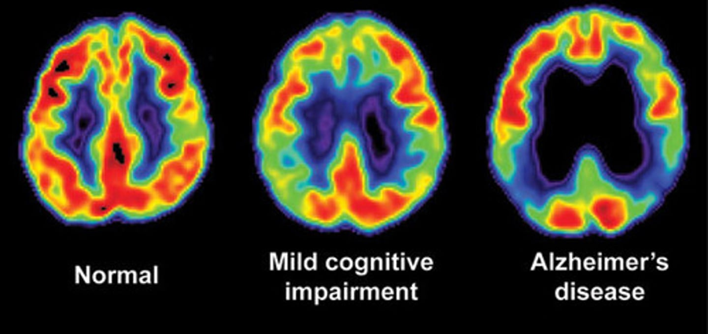 <p>a visual display of brain activity that detects where a radioactive form of glucose goes while the brain performs a given task</p>