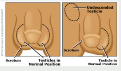 <p><strong>Cryptorchidism</strong></p><p>-Absent testis or ____________ testis </p><p>-Physical exam → atrophic ________ on affected side, __ palpable testis</p>