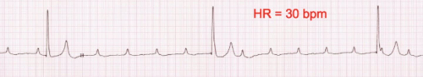 <p>Name the arrhythmia.</p>