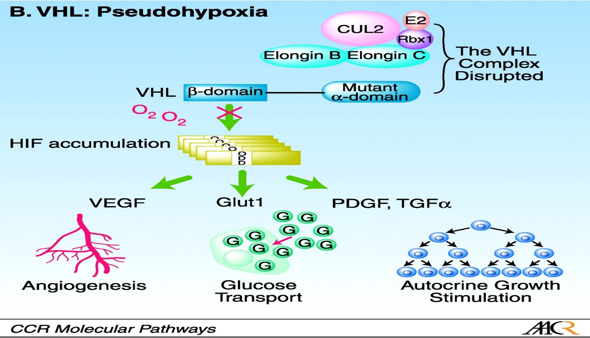 <p>•a lack of regulation of cell growth and survival, allowing cells to grow and divide uncontrollably.</p><p><span>•Normoxia – but HIF-α is not targeted for degradation.</span></p><p>•&gt; 370 inherited mutations in VHL gene.</p><p>Ø80% cases are missense mutations.</p><p>20% large germline deletions.</p>