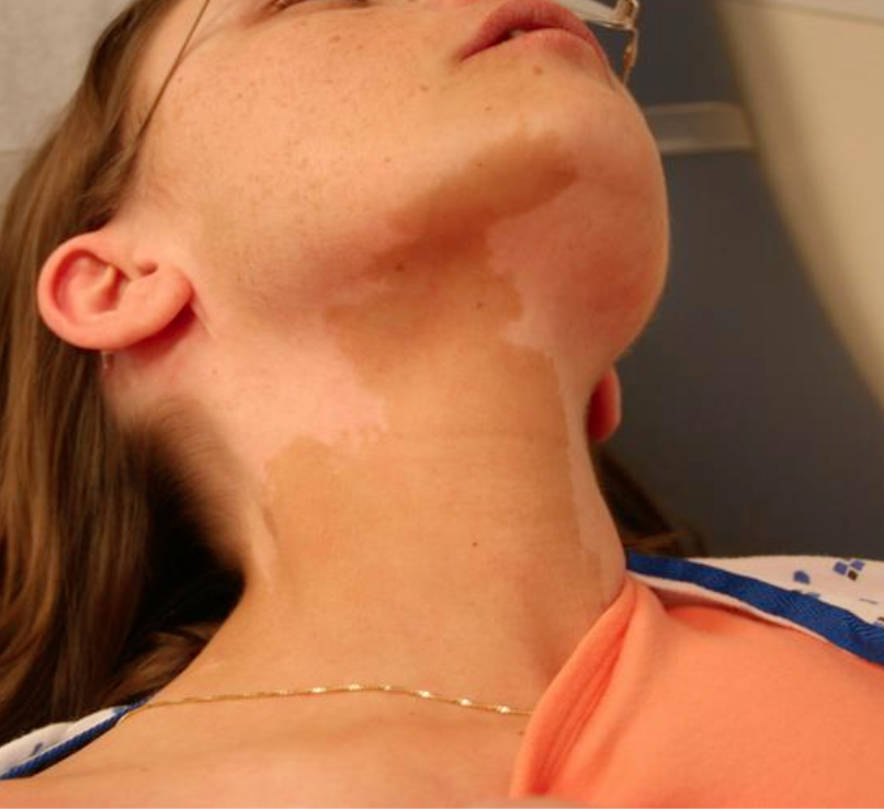 <p>Cafe au lait spots in McCune Albright Syndrome</p>