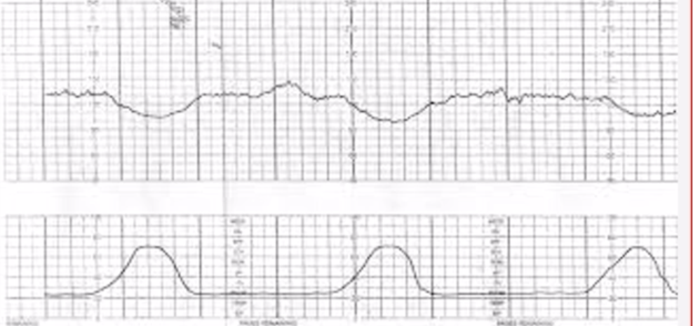 <p>-Not a concern due to Head compression</p><p>-Slow &amp; gradual </p><p>Causes: Active stage of labor, pushing, crowning</p>