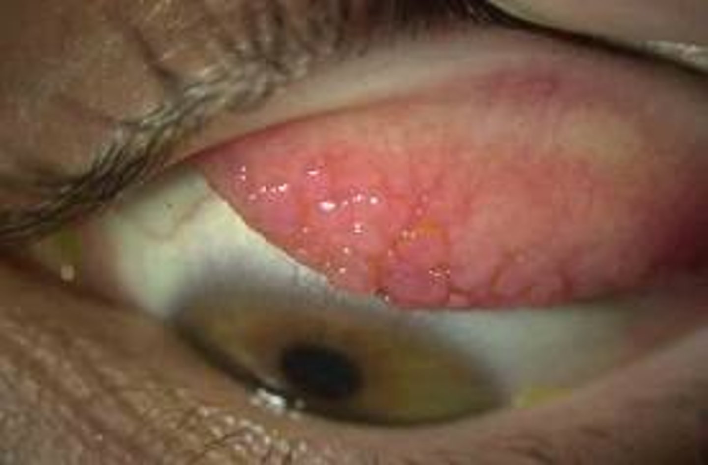 <p>Cause:</p><p>◦Inflammation of conjunctiva</p><p>◦IgE mediated response and Mast Cell degranulation</p><p>◦Increased vascular permeability</p><p>Clinical Features:</p><p>◦Conjunctival Injection (Erythema) + edema (chemosis) + Folliculitis (papillary edema)</p><p>Common Allergens:</p><p>◦Cats</p><p>◦Smoke</p><p>◦Pollen</p>