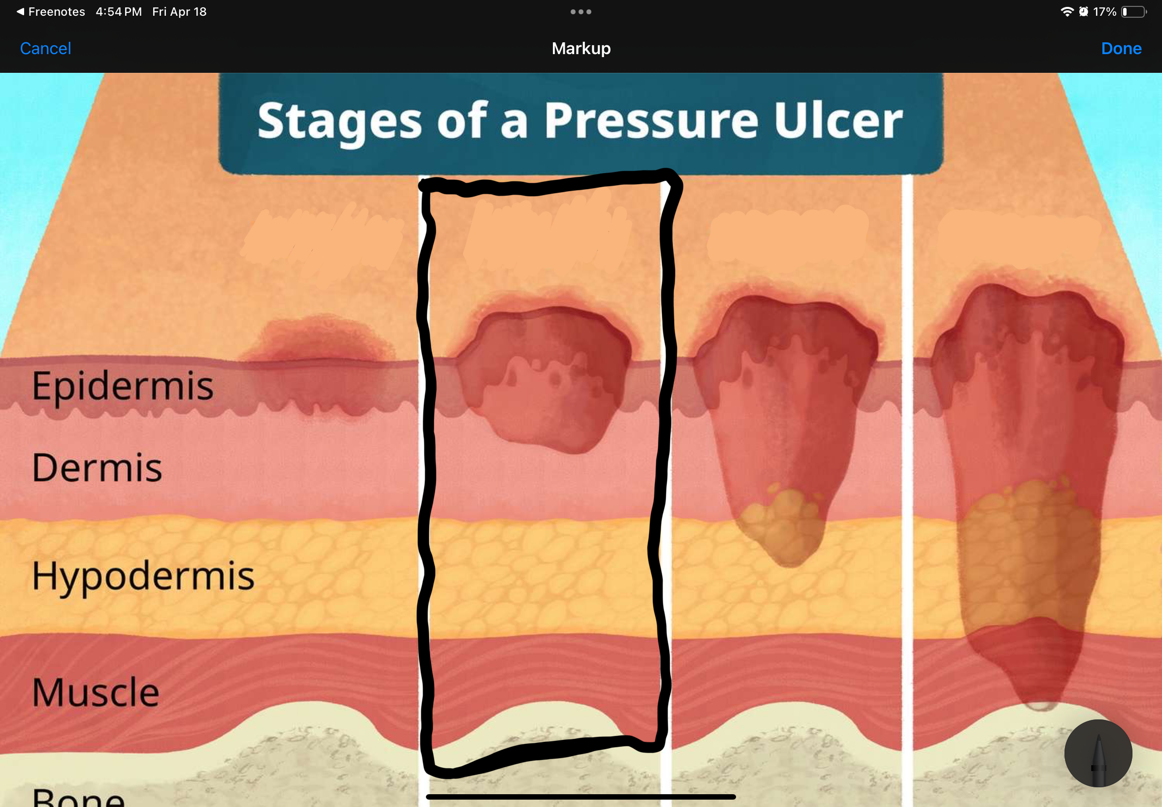 <p>Name and describe the stage of this pressure uncler</p>