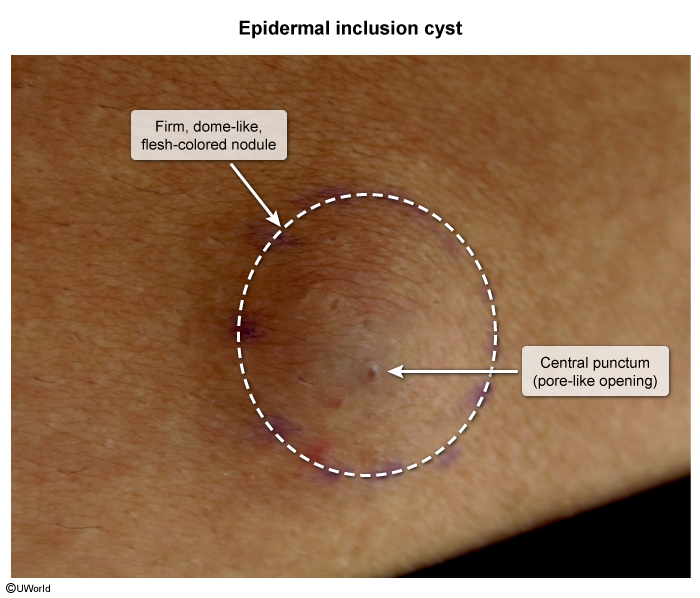 <p>epidermal inclusion cyst</p>