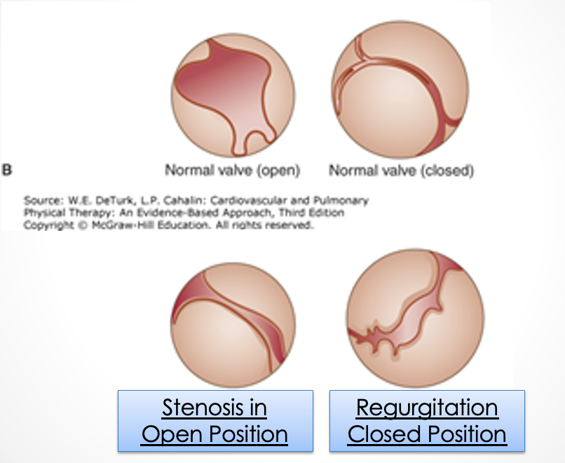 <p>stenosis </p>