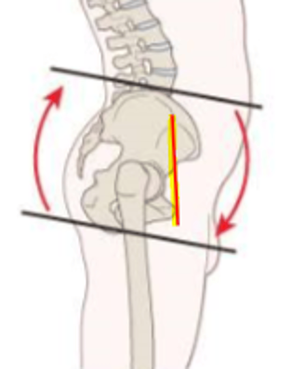 <p>force couple of hip flexors and back extensors</p><p>*ASIS is anterior to PS = hip flexion</p>