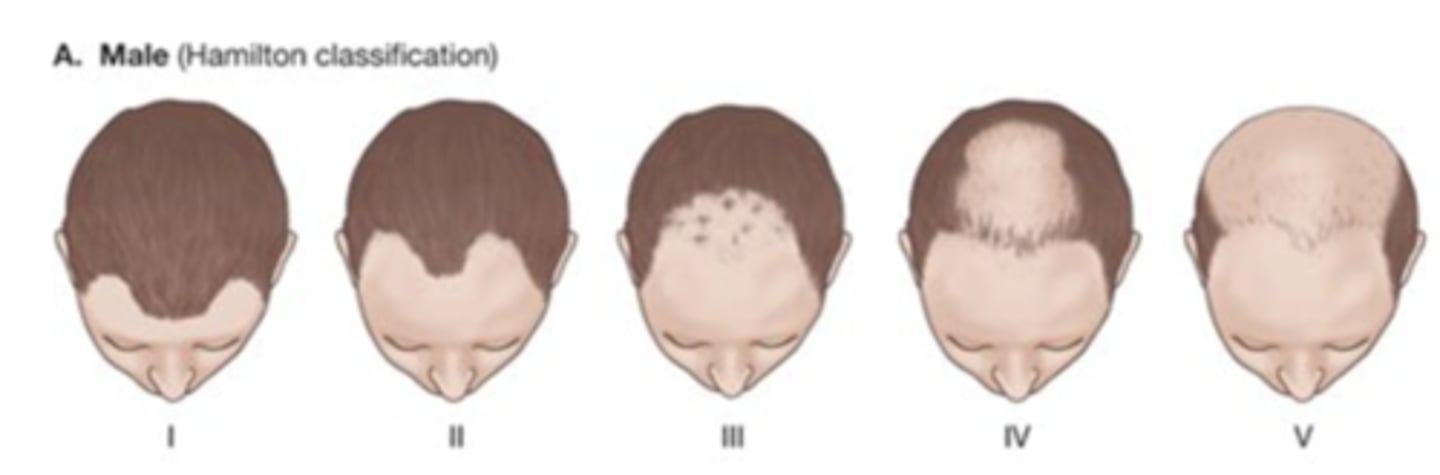 <p>Stages of male pattern hair loss</p>