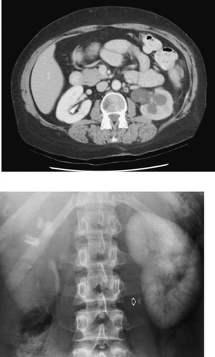<p>- What pathology is caused by a stone, tumor, stricture, enlarged prostate, congenital anomaly, or pregnancy?</p><p>- What can happen to the ureters and kidneys?</p><p>- What imaging modalities are used to see this pathology?</p>