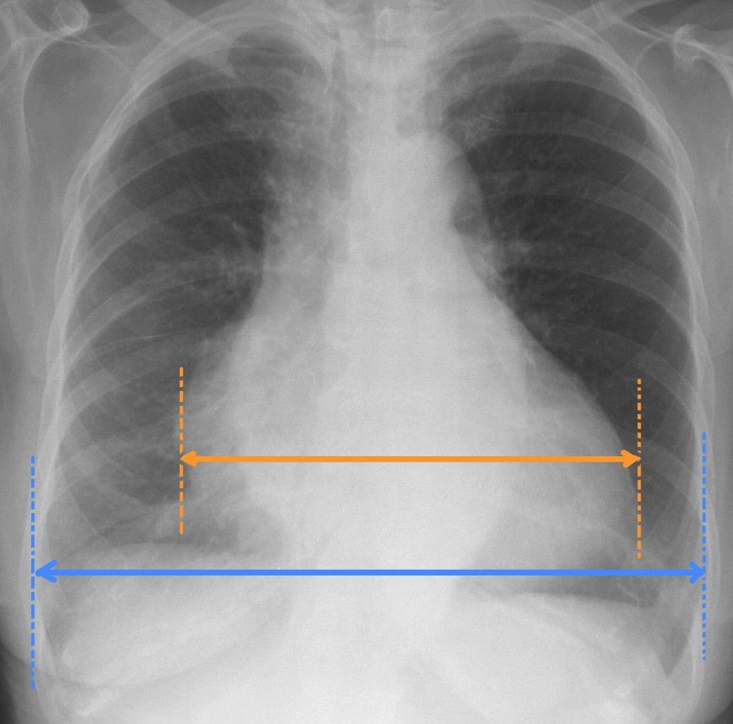 <p>Cardiothoracic ratio</p>
